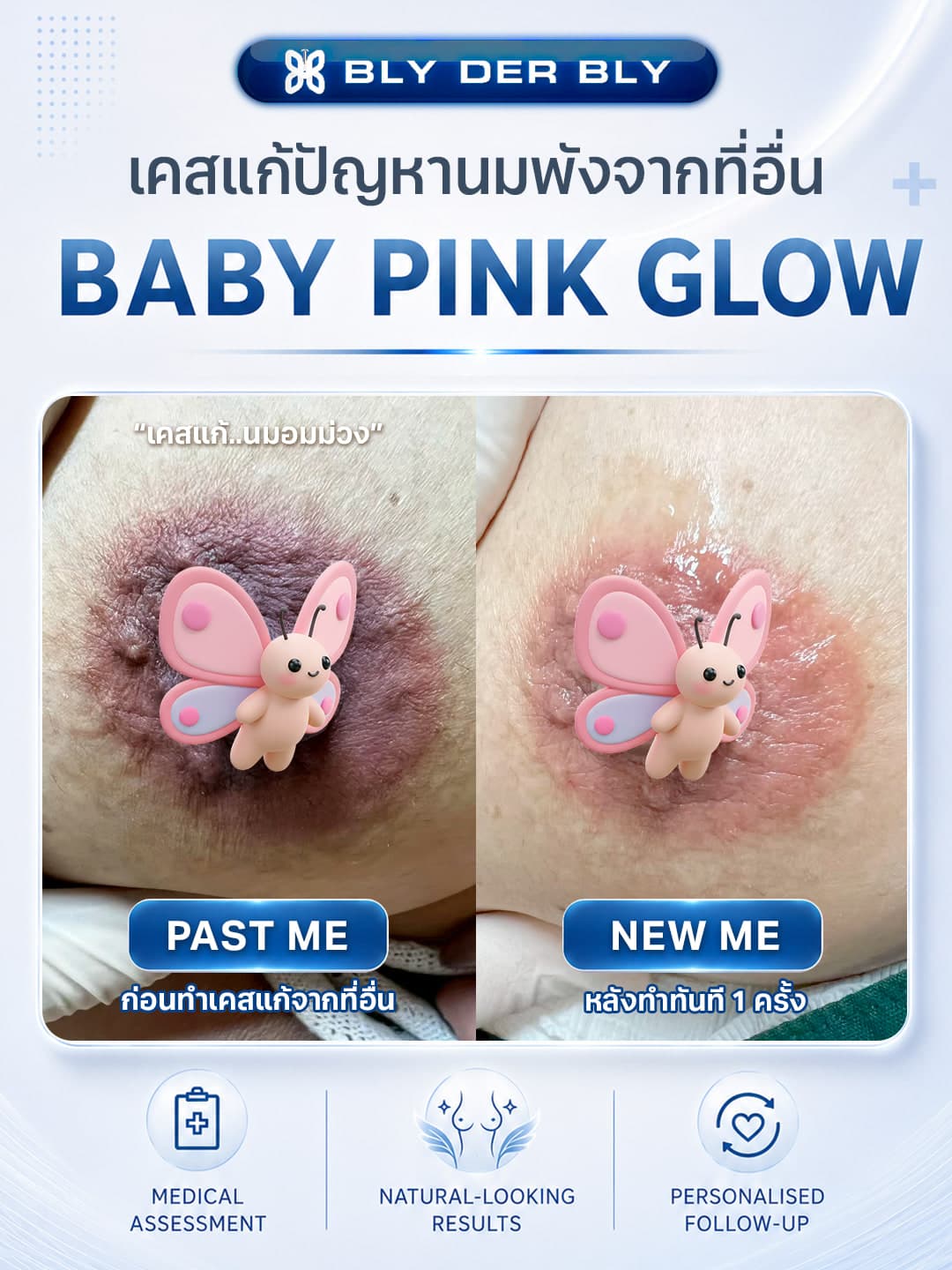 ภาพเปรียบเทียบโทนสีลานนม ก่อนดูแลและหลังดูแล 1 ครั้ง