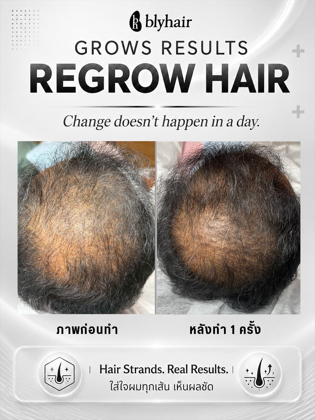 ภาพเปรียบเทียบความหนาแน่นของเส้นผมบริเวณกลางศีรษะ ก่อนดูแลและหลังดูแล 1 ครั้ง