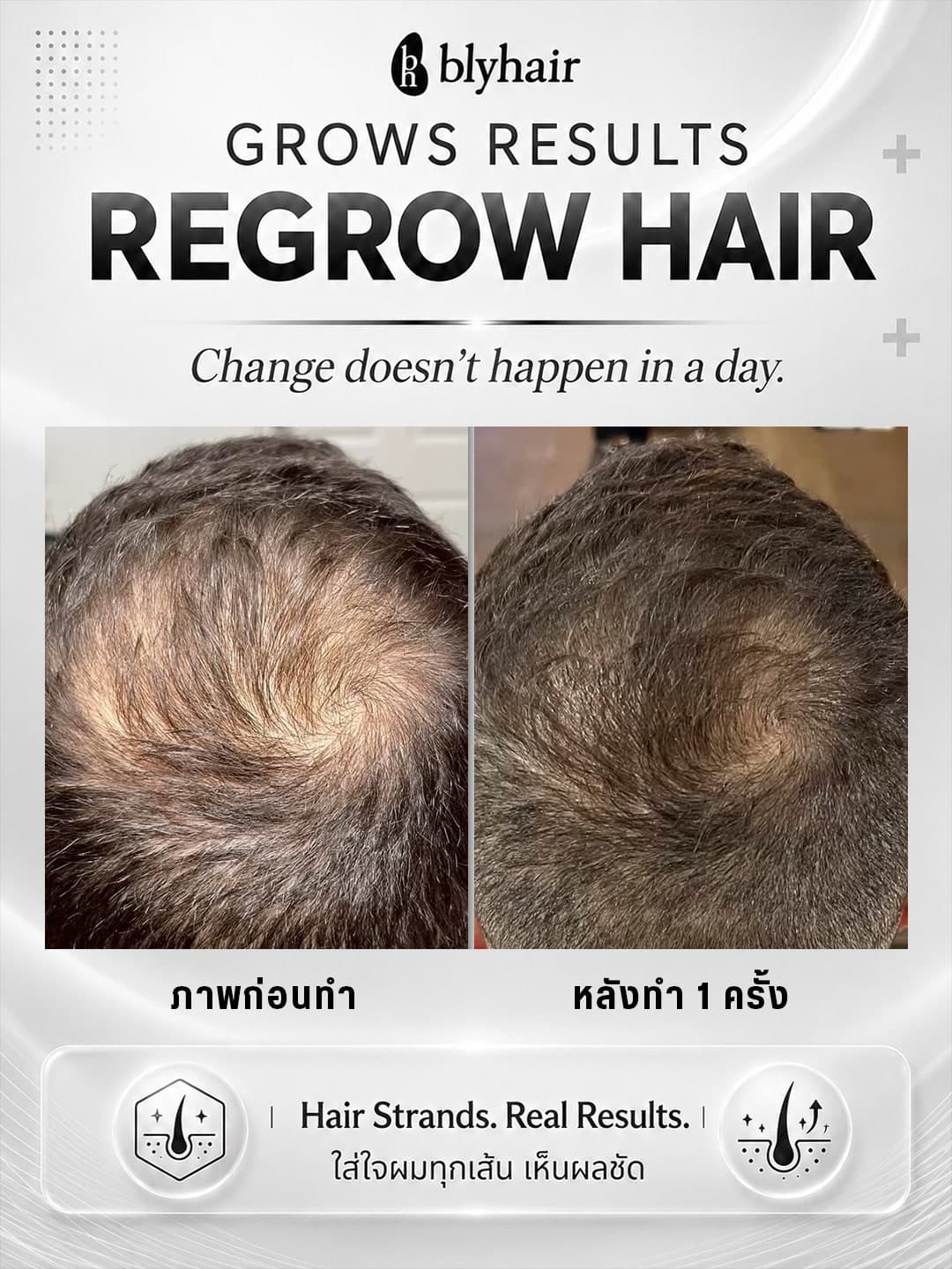 ภาพเปรียบเทียบความหนาแน่นของเส้นผมบริเวณกลางศีรษะ ก่อนดูแลและหลังดูแล 1 ครั้ง