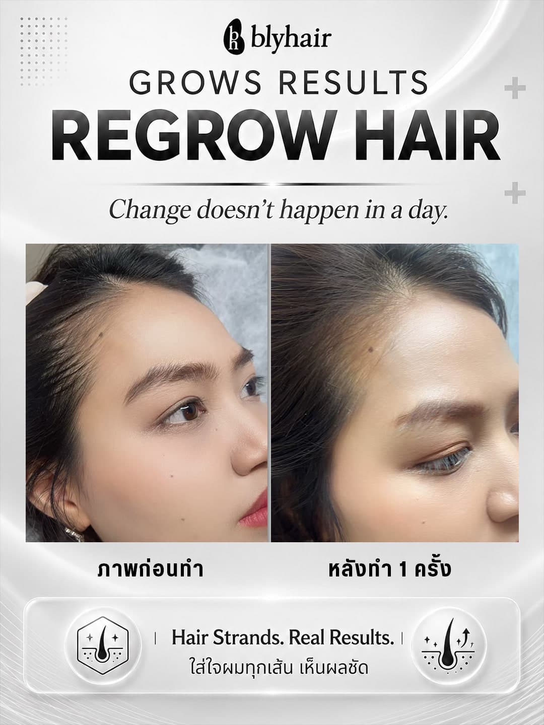ภาพเปรียบเทียบแนวผมหน้าผาก ก่อนดูแลและหลังดูแล 1 ครั้ง