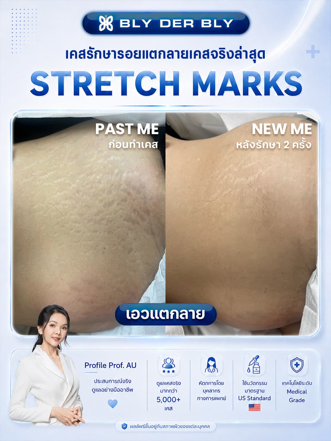 ภาพเปรียบเทียบรอยแตกลายบริเวณหน้าท้อง ก่อนดูแลและหลังดูแล 2 ครั้ง