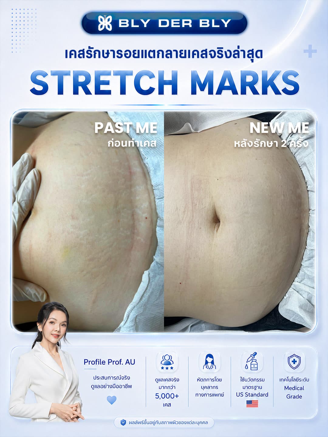 ภาพเปรียบเทียบรอยแตกลายบริเวณหน้าท้อง ก่อนดูแลและหลังดูแล 2 ครั้ง
