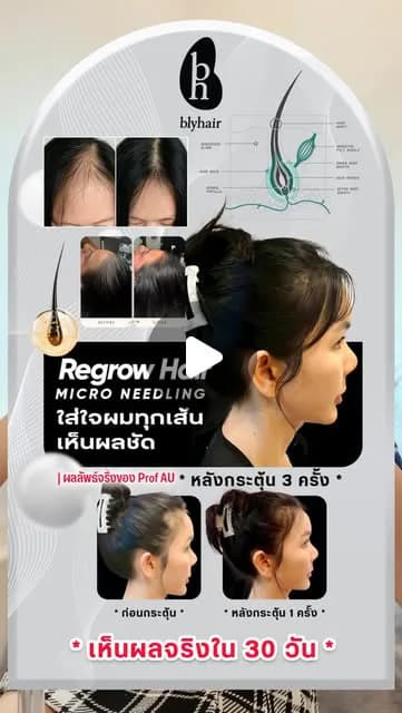 ภาพปกคลิป ผมบางควรเริ่มดูแลเมื่อไร ก่อนความมั่นใจลดลง