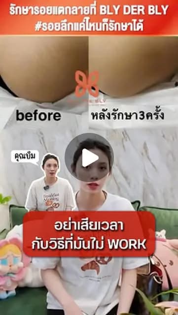 ภาพปกคลิป คุณบีมเล่าประสบการณ์ดูแลรอยแตกลายที่สะโพกและก้น