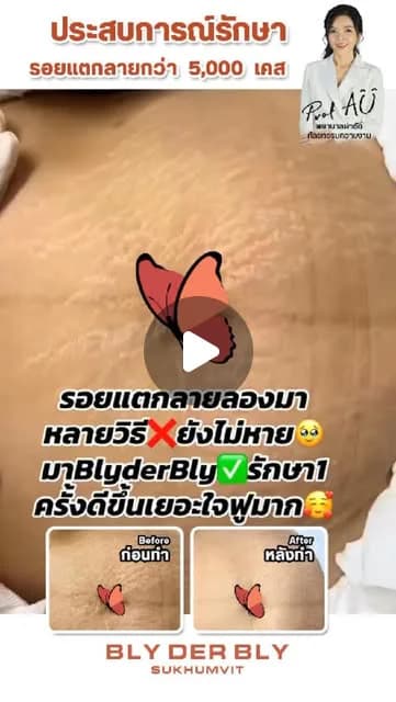 ภาพปกคลิป ท้องแตกลายลุกลามได้หรือไม่ Prof. AU อธิบาย