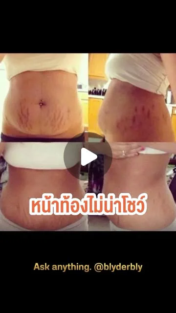 ภาพปกคลิป รีวิวคุณแม่หลังคลอด วางแผนดูแลรอยแตกลายอย่างไร