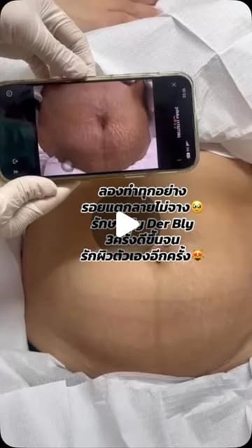 ภาพปกคลิป คุณแม่หลังคลอดเล่าความกังวลเรื่องหน้าท้องแตกลาย