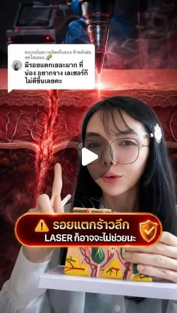 ภาพปกคลิป ก่อนเลือกเลเซอร์รอยแตกลาย ต้องเช็กอะไรบ้าง